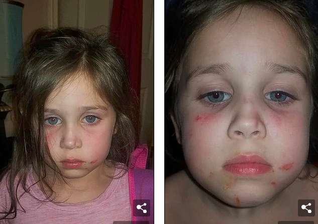 5歲的女孩臉上滿是瘀傷，原來在校車上被毆打了45分鐘