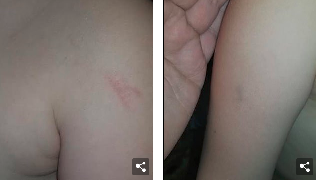 5歲的女孩臉上滿是瘀傷，原來在校車上被毆打了45分鐘